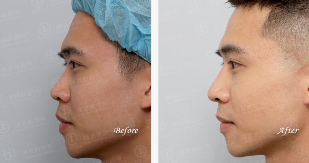 韓式隆鼻,結構式隆鼻,博恩妍